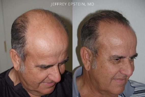 Trasplante de Pelo en Hombres Before and after in Miami, FL, Paciente 80608