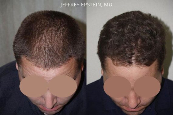 Trasplante de Pelo en Hombres Before and after in Miami, FL, Paciente 80327