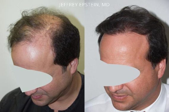 Trasplante de Pelo en Hombres Before and after in Miami, FL, Paciente 79881