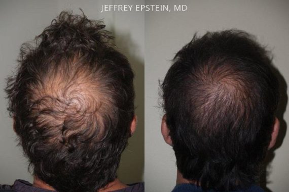 Trasplante de Pelo en Hombres Before and after in Miami, FL, Paciente 79705