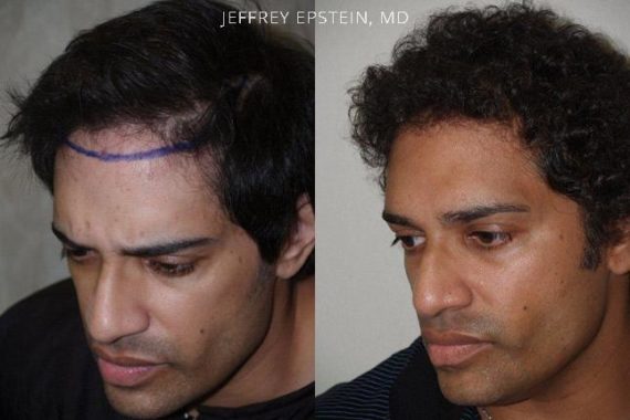 Trasplante de Pelo en Hombres Before and after in Miami, FL, Paciente 79345