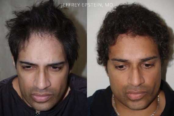 Trasplante de Pelo en Hombres Before and after in Miami, FL, Paciente 79345