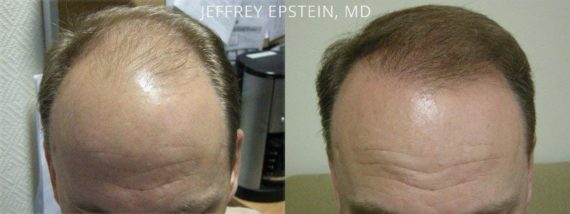 Trasplante de Pelo en Hombres Before and after in Miami, FL, Paciente 79290