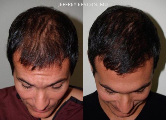 Trasplante de Pelo en Hombres Before and after in Miami, FL, Paciente 79086