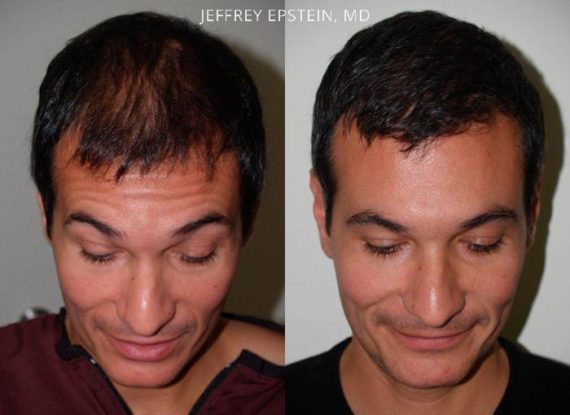 Trasplante de Pelo en Hombres Before and after in Miami, FL, Paciente 79086