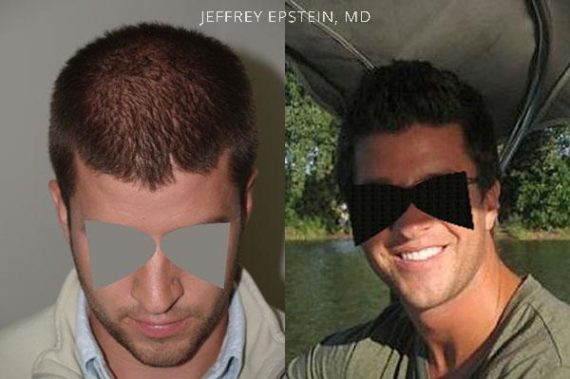 Trasplante de Pelo en Hombres Before and after in Miami, FL, Paciente 79042