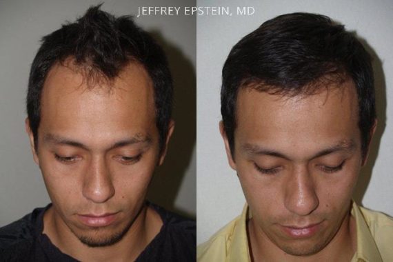 Trasplante de Pelo en Hombres Before and after in Miami, FL, Paciente 78862