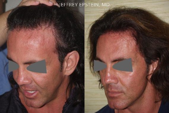 Trasplante de Pelo en Hombres Before and after in Miami, FL, Paciente 78551