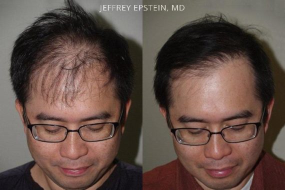 Trasplante de Pelo en Hombres Before and after in Miami, FL, Paciente 78047