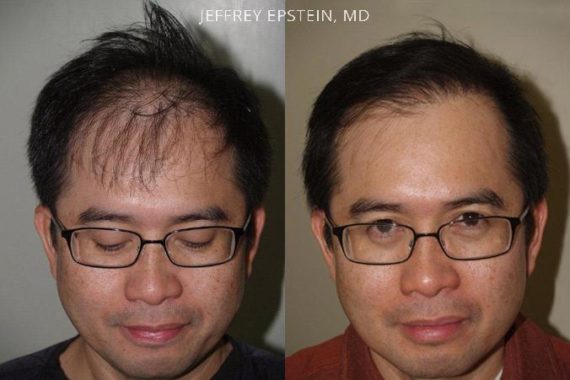 Trasplante de Pelo en Hombres Before and after in Miami, FL, Paciente 78047