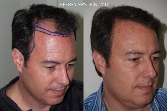 Trasplante de Pelo en Hombres Before and after in Miami, FL, Paciente 77947