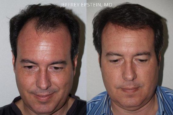 Trasplante de Pelo en Hombres Before and after in Miami, FL, Paciente 77947