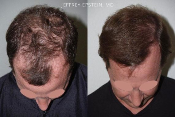 Trasplante de Pelo en Hombres Before and after in Miami, FL, Paciente 77844