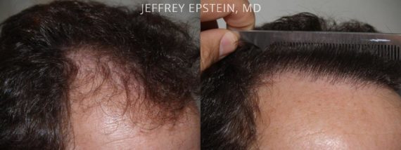 Trasplante de Pelo en Hombres Before and after in Miami, FL, Paciente 77415