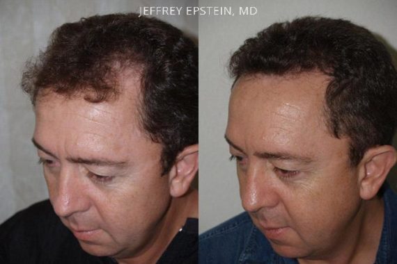 Trasplante de Pelo en Hombres Before and after in Miami, FL, Paciente 77415