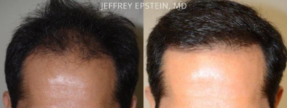 Trasplante de Pelo en Hombres Before and after in Miami, FL, Paciente 76768