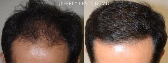 Trasplante de Pelo en Hombres Before and after in Miami, FL, Paciente 76768