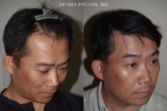 Trasplante de Pelo en Hombres Before and after in Miami, FL, Paciente 76667