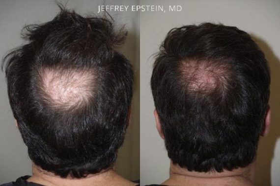 Trasplante de Pelo en Hombres Before and after in Miami, FL, Paciente 76614