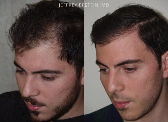 Trasplante de Pelo en Hombres Before and after in Miami, FL, Paciente 76312