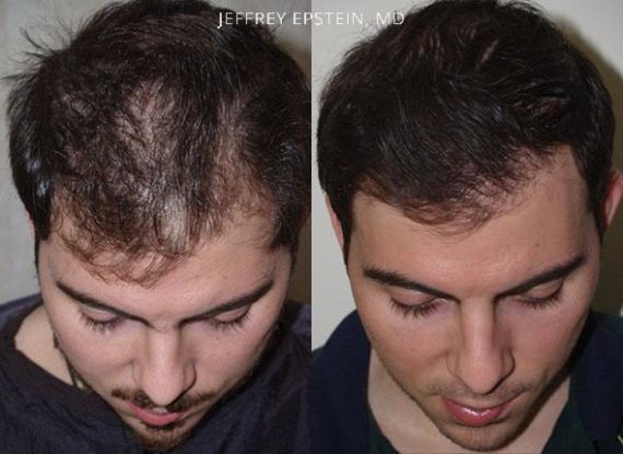 Trasplante de Pelo en Hombres Before and after in Miami, FL, Paciente 76312