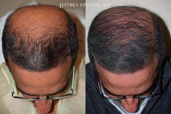 Trasplante de Pelo en Hombres Before and after in Miami, FL, Paciente 76250