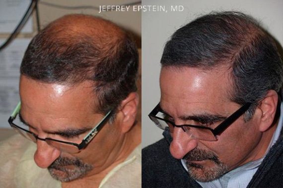 Trasplante de Pelo en Hombres Before and after in Miami, FL, Paciente 76250