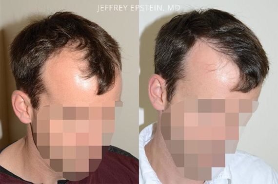 Trasplante de Pelo en Hombres Before and after in Miami, FL, Paciente 75955