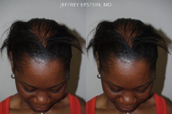 Trasplante de Pelo en Mujeres Before and after in Miami, FL, Paciente 102393