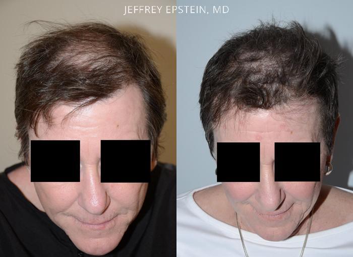 Hair Transplants For Women Pictures Miami Fl Paciente 42107
