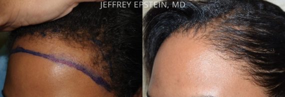 Trasplante de Pelo en Mujeres Before and after in Miami, FL, Paciente 99108