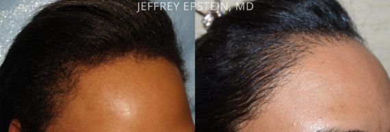 Trasplante de Pelo en Mujeres Before and after in Miami, FL, Paciente 99108