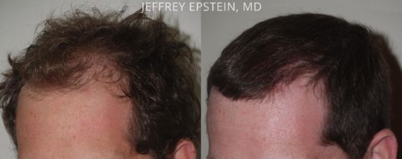 Trasplante de Pelo en Hombres Before and after in Miami, FL, Paciente 75402