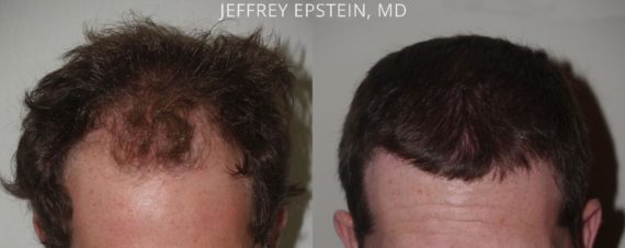 Trasplante de Pelo en Hombres Before and after in Miami, FL, Paciente 75402