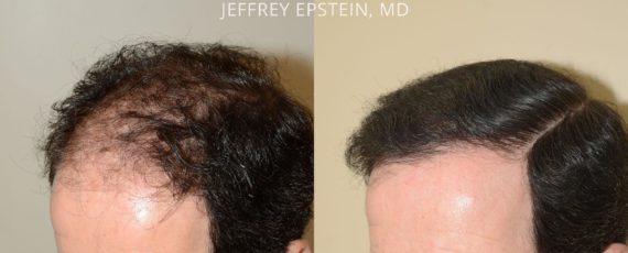 Trasplante de Pelo en Hombres Before and after in Miami, FL, Paciente 74845