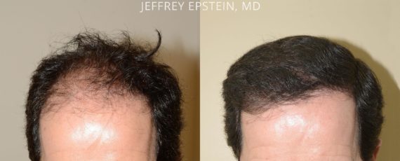 Trasplante de Pelo en Hombres Before and after in Miami, FL, Paciente 74845