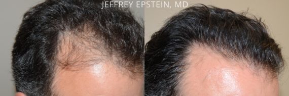 Trasplante de Pelo en Hombres Before and after in Miami, FL, Paciente 74495