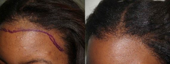 Hair Transplants For Women Photos Miami Fl Patient41426