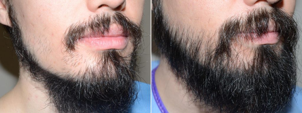 Facial Hair Transplant photos | Miami, FL | Patient58902