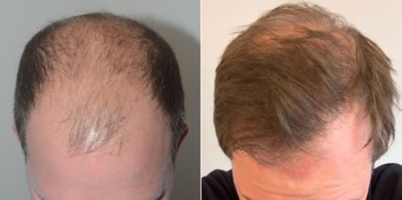 Trasplante de Pelo en Hombres Before and after in Miami, FL, Paciente 74278