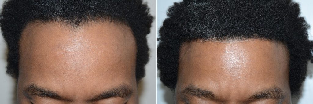 Hairline Advancement Before After 3 1024x341 