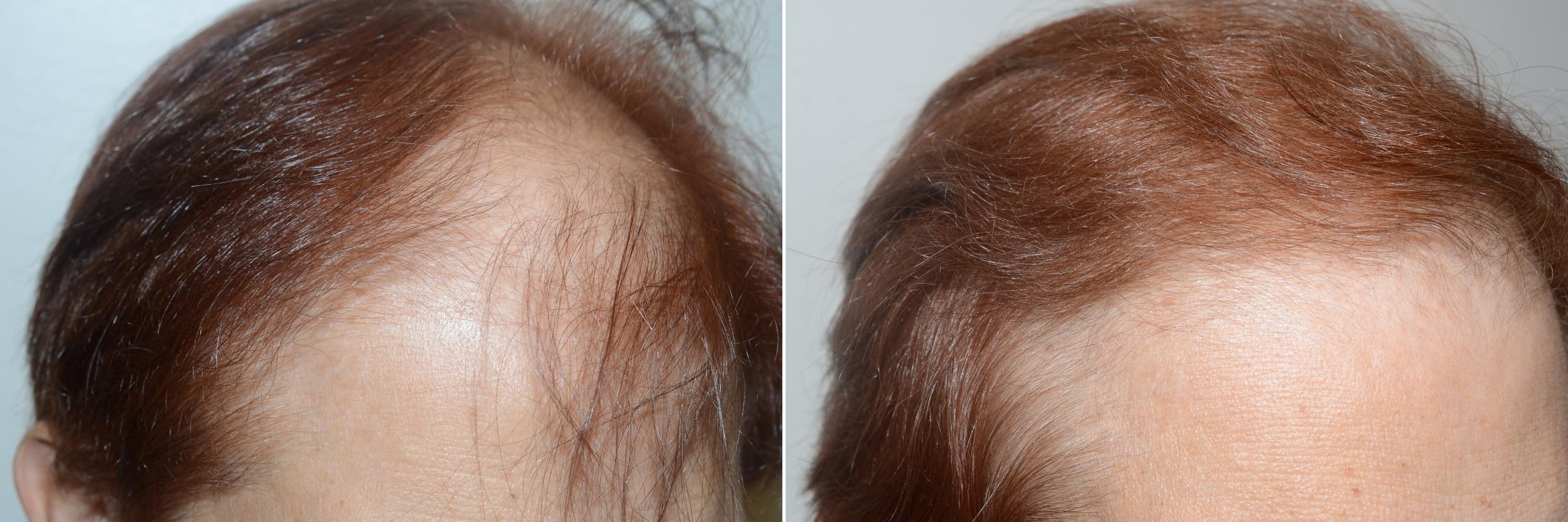 Hair Transplants For Women Photos Miami Fl Patient59153