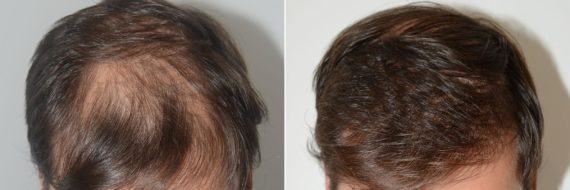 Trasplante de Pelo en Hombres Before and after in Miami, FL, Paciente 74195