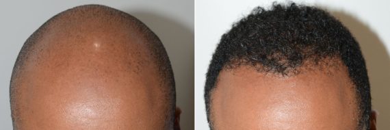 Trasplante de Pelo en Hombres Before and after in Miami, FL, Paciente 74047