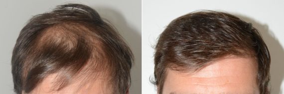 Trasplante de Pelo en Hombres Before and after in Miami, FL, Paciente 74195