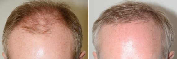 Trasplante de Pelo en Hombres Before and after in Miami, FL, Paciente 74145