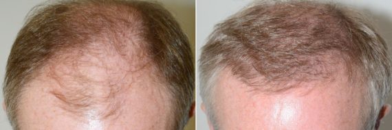 Trasplante de Pelo en Hombres Before and after in Miami, FL, Paciente 74145