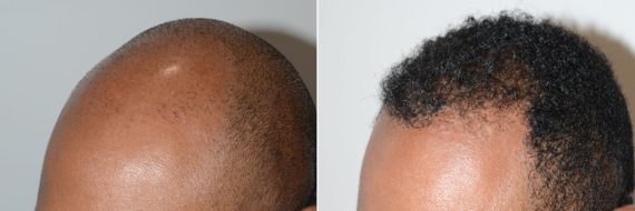 Trasplante de Pelo en Hombres Before and after in Miami, FL, Paciente 74047