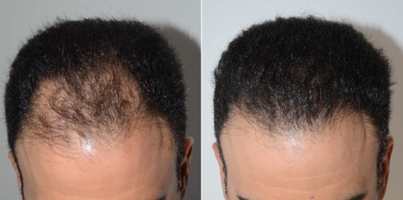 Trasplante de Pelo en Hombres Before and after in Miami, FL, Paciente 73986