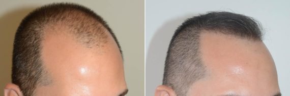 Trasplante de Pelo en Hombres Before and after in Miami, FL, Paciente 73961